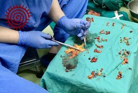 A surgical trainee removes lymph nodes from a specimen. Photo by the author, 2019, with permission from the surgical trainee.