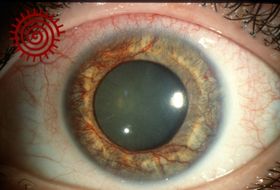 Abnormal proliferation of blood vessels on the surface of the iris, as seen during an eye examination. Image by James Gilman. In the Moran CORE collection, CC BY-NC-ND 4.0.